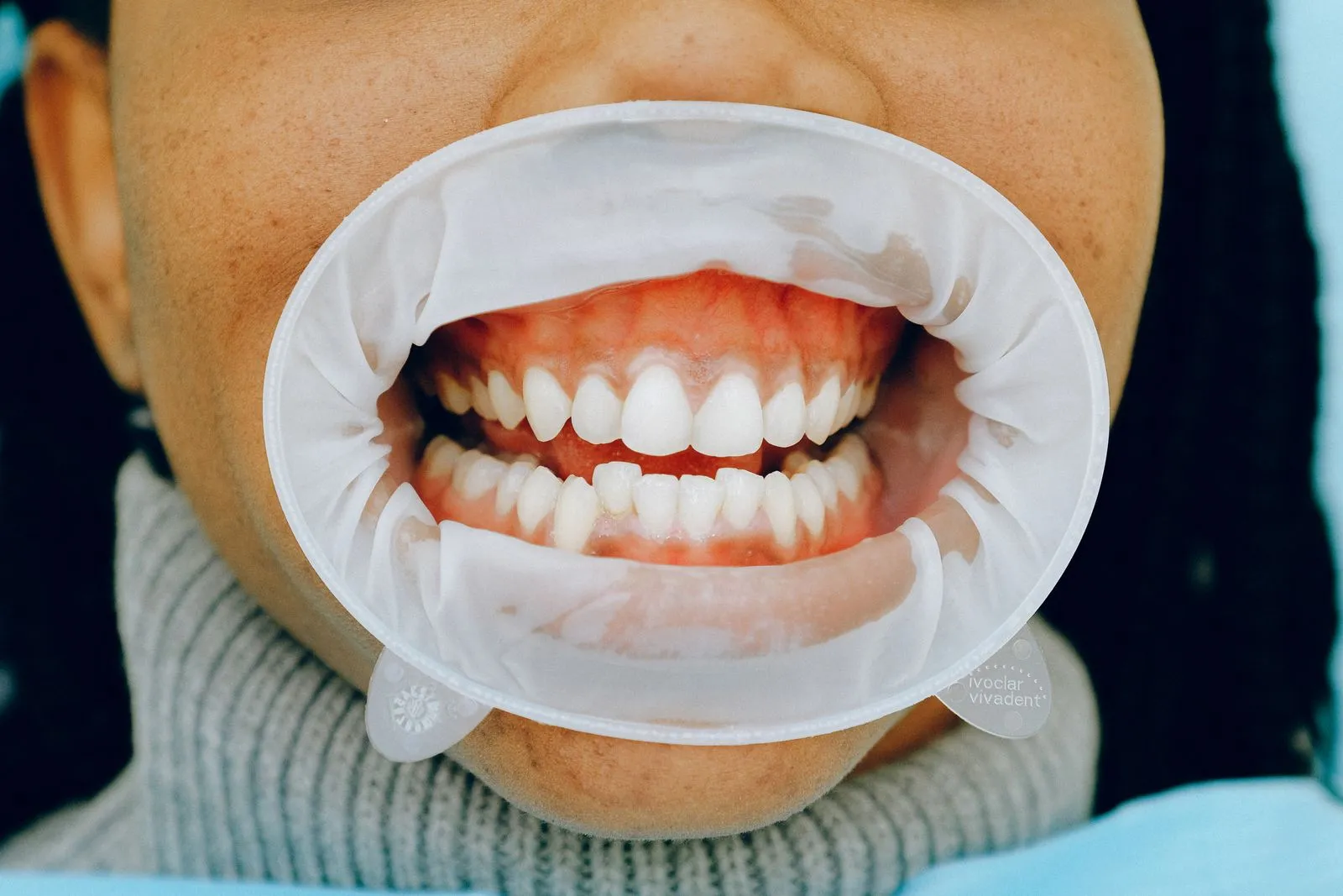 Primer plano de una boca con separador mostrando dientes y encías sanas, Clínica Dental Cendón
